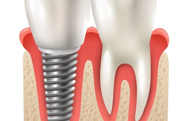 Dental implants